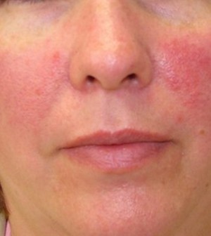 Image result for red skin irritation on face